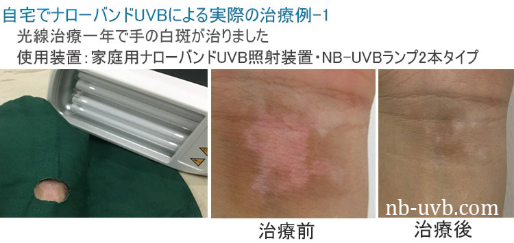 家庭用ナローバンドUVB(311)/エキシマ(308)紫外線治療器[個人輸入 